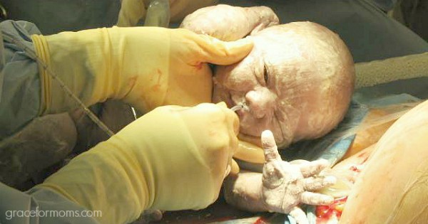 What an Emergency C-Section is Really Like